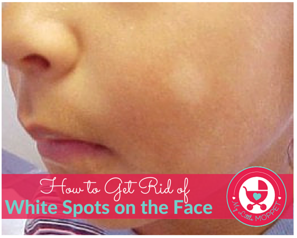 how to get rid of white spots on the face