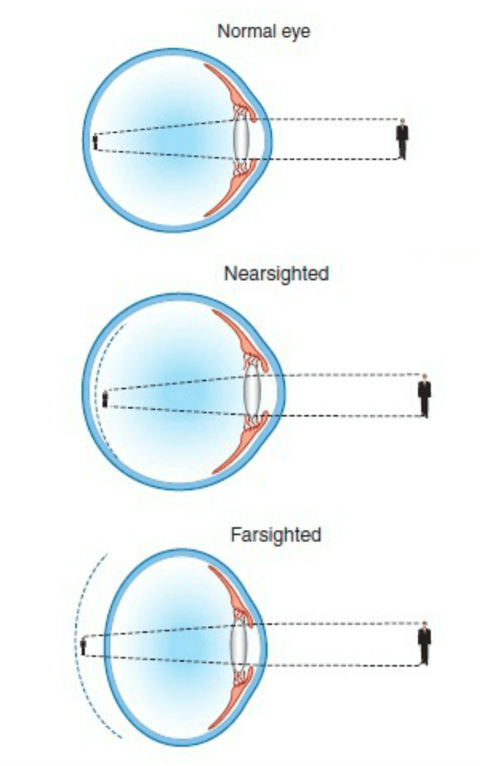 what causes refractive error in children