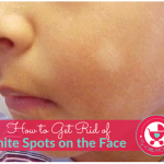 How to get rid of white spots on face of your child
