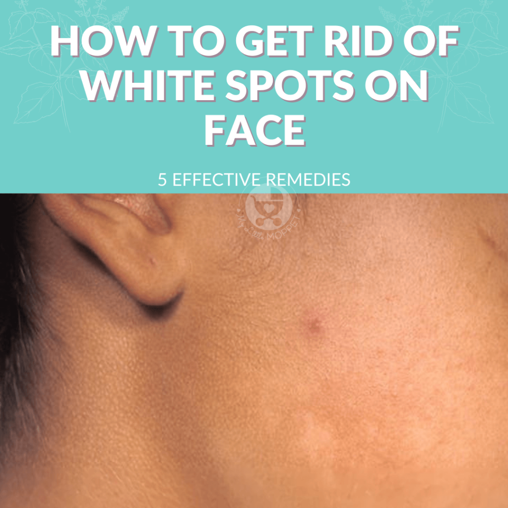 how to get rid of white spots on the face of your child