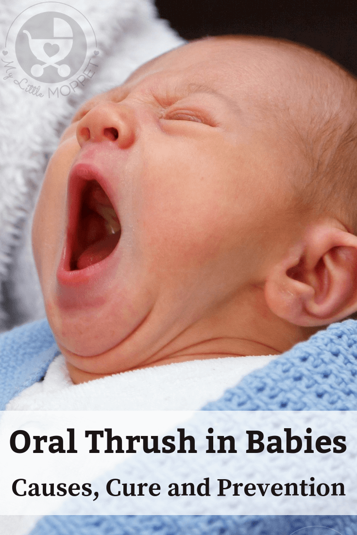 Oral Thrush in Babies is mostly harmless but can cause some discomfort. Learn all about what causes oral thrush, how to prevent it & keep baby's tongue clean.