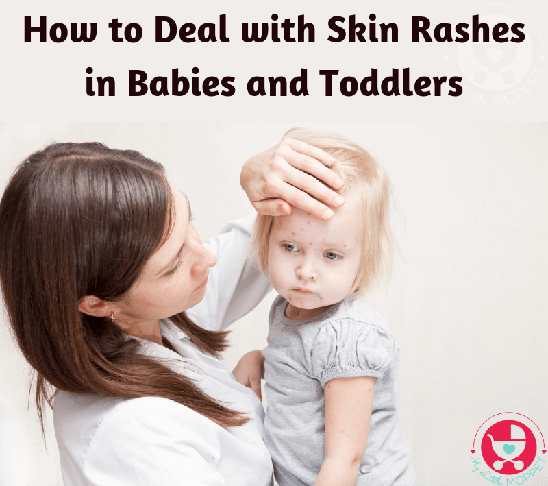 Seeing a rash pop up on your baby's delicate skin can be distressing for you and your baby. Here is a guide to deal with skin rashes in babies and toddlers.