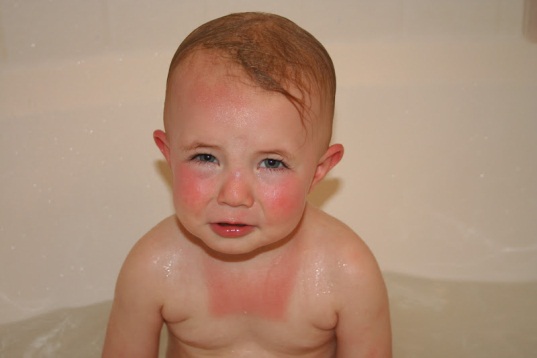 Skin Rashes in Babies and Toddlers